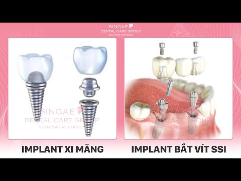 Video Đừng chọn trồng răng Implant giá rẻ nếu bạn chưa biết... - youtube