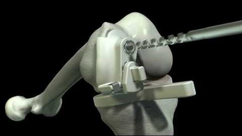 iUni Surgical Technique Animation