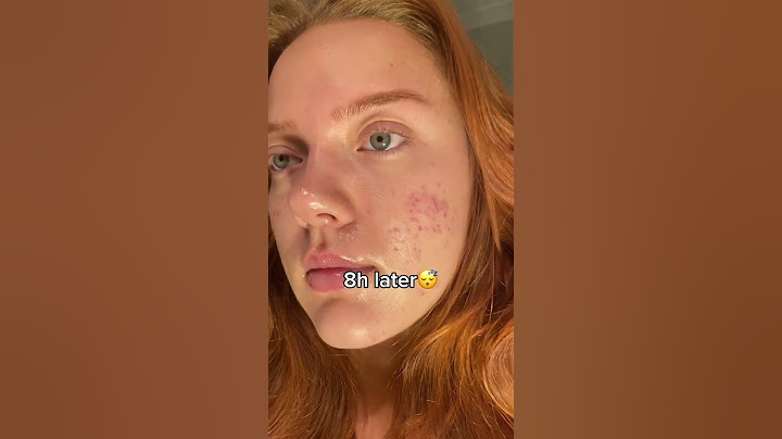 How to pop a pimple without scarring💙  #acneproneskin #acne