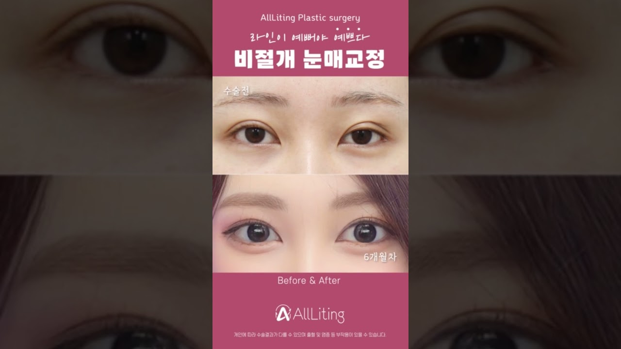 Оллитинг Гоо сайхны мэс заслын эмнэлэг
#Зүсэлттэй_давхраа_засах_мэс_засал хэтэрхий хүнд санагдаж байвал яах вэ?! #Зүсэлтгүй_давхраа_засах_мэс_засал-аар тансаг #се