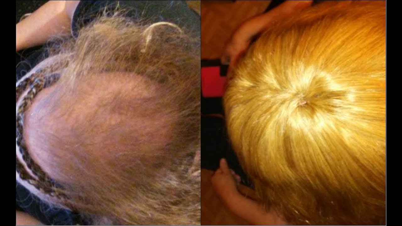 Do You Have Thin Hair This Video Is For You Partial Sew In On