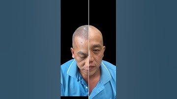 Anh ấy đã làm điều này khi bị hói. #xămchântóc