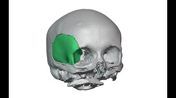 Preoperative planning of the resection of a hyperostotic meningioma with a surgical guide