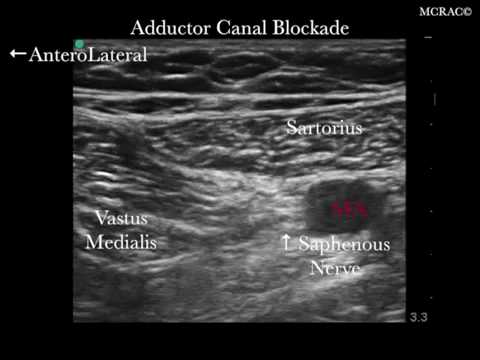 ASA 2016 Ultrasound Guided Adductor Canal Block (blockade) Femoral