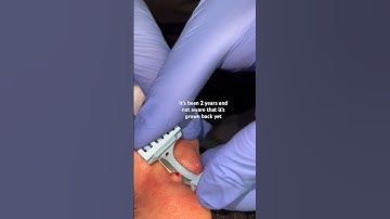 How Dermatologists remove moles with before and after #shorts