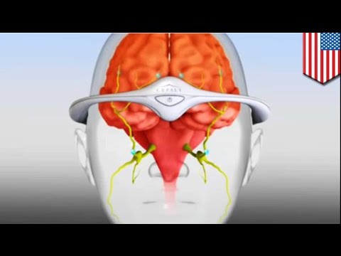 A cure for migraine? $300 prevention device approved for market