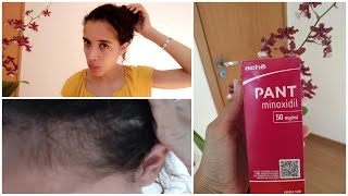 Minoxidil PANT / 3 meses de USO 😲😱😍❤️ 