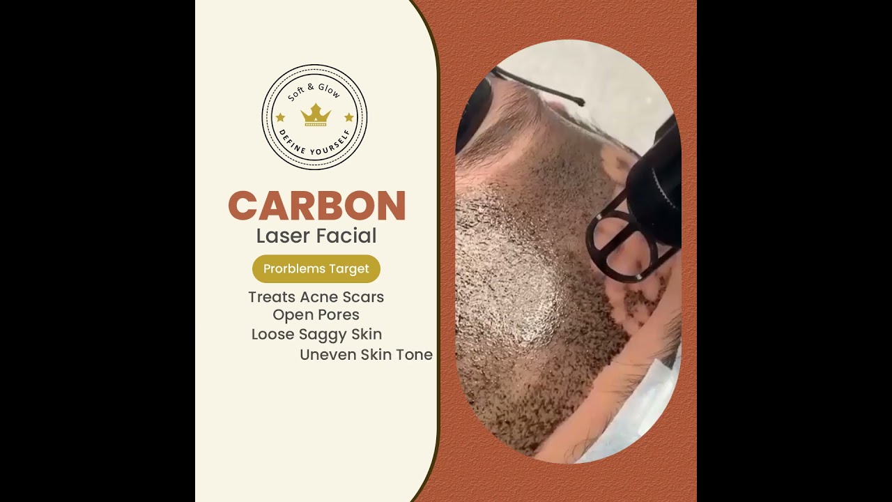 Carbon Laser for Glowing skin