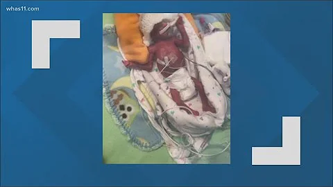 Baby thriving after being born prematurely