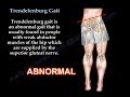 Trendelenburg Gait - Everything You Need To Know - Dr. Nabil Ebraheim