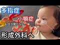 【4pマイナス症候群】多指症と1㎝しか開かないお口をみてもらいました。
