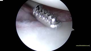 Right Shoulder Revision Plication 4 18 16 HK