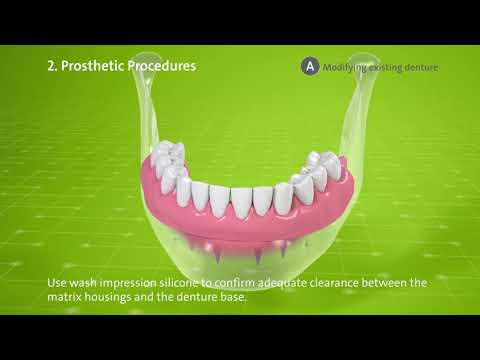 Straumann® Mini Implant System Step by Step