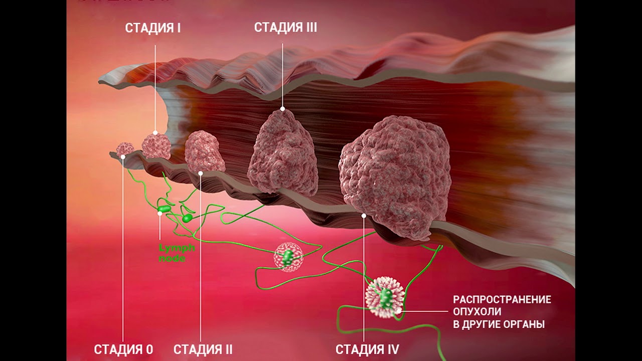 Первые признаки рака молочной железы у женщин на ранней стадии какие фото