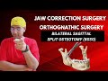 Dr rudra mohan bilateral sagittal split osteotomy bsso  jaw correction orthognathic surgery