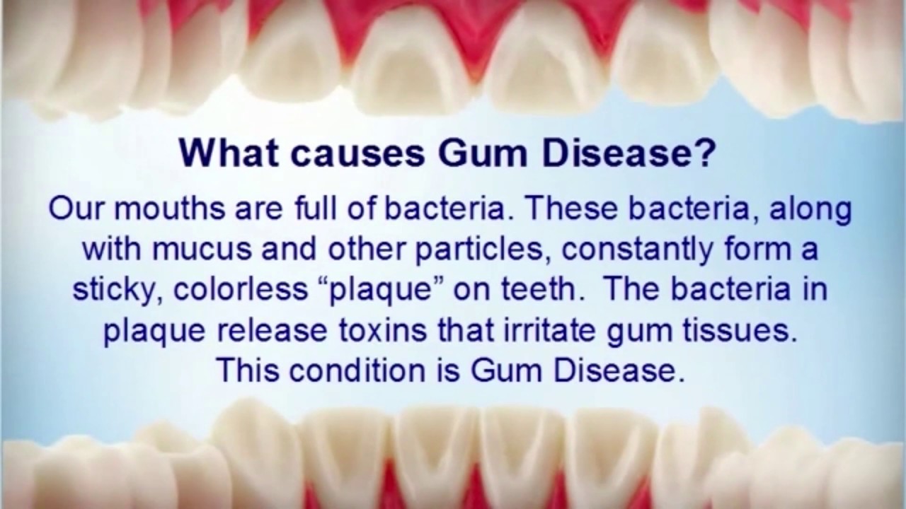 Understanding Gum Disease Dr Robertson And Dr Redd Dental Health Understanding gum disease dr robertson and dr redd dental health