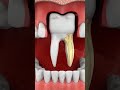Why Losing One Tooth Changes Your Face Forever