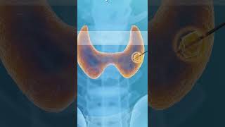 Symptoms of Thyroid Nodules Explained | Maven Medical Center