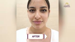 Yara had visited Tajmeel Clinic to get the lips she always dreamt of.
