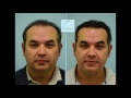 Tony's Testimonial at 6 Months after Hair Transplant in Dallas, TX