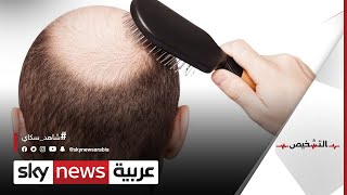 علاج تساقط الشعر بطريقة فعالة جدا  |#التشخيص