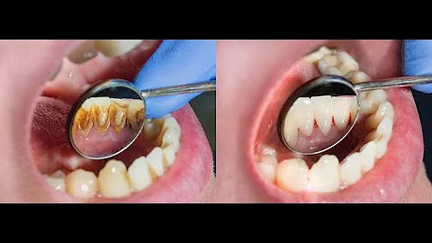 ¿Qué esperar después de una limpieza periodontal?