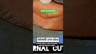 बिना किसी बाहरी चीरा  टांका निशान कान का सफल ऑपरेशन #ashokbest jaipur 88245 44291 👂 कोसांबी के जवान