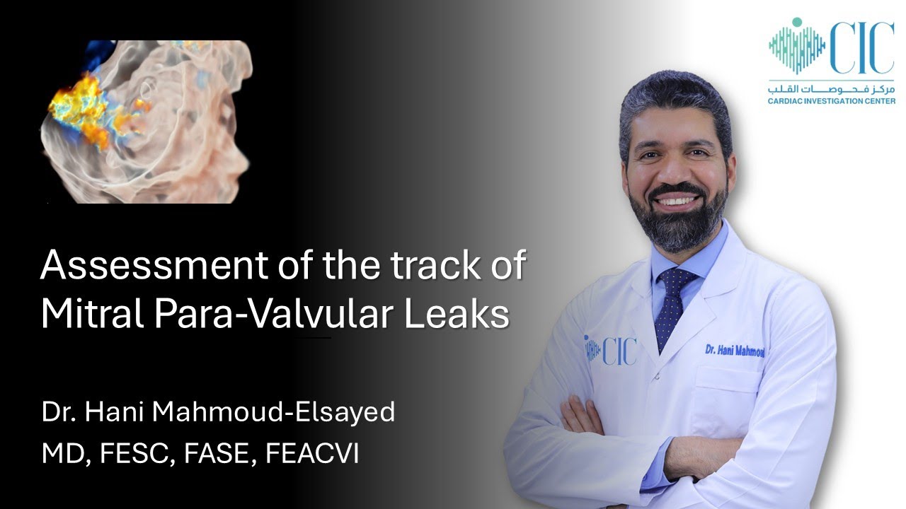 Assessment of the track of Mitral Para-Valvular Leaks