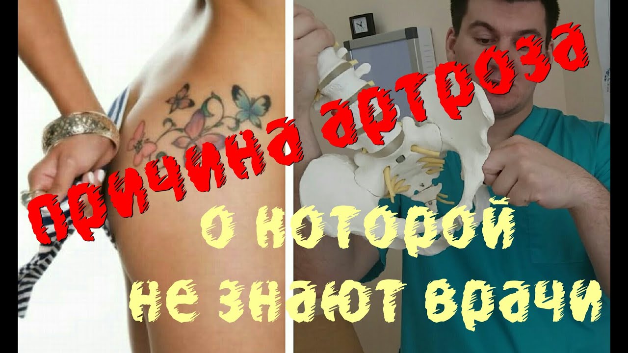 Причины артроза о которых не знают врачи. Causes of osteoarthritis which doctors do not know