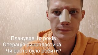 Операція на носі. Ринопластика . До чого потрібно було бути готовим?  (1частина)