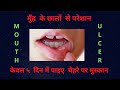 8      i  best treatment for mouth ulcers i  by dr rupesh amale