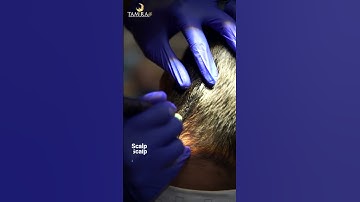 Scalp Micropigmentation for Scar