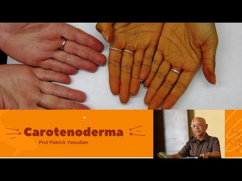 Carotenoderma - a condition worth knowing!