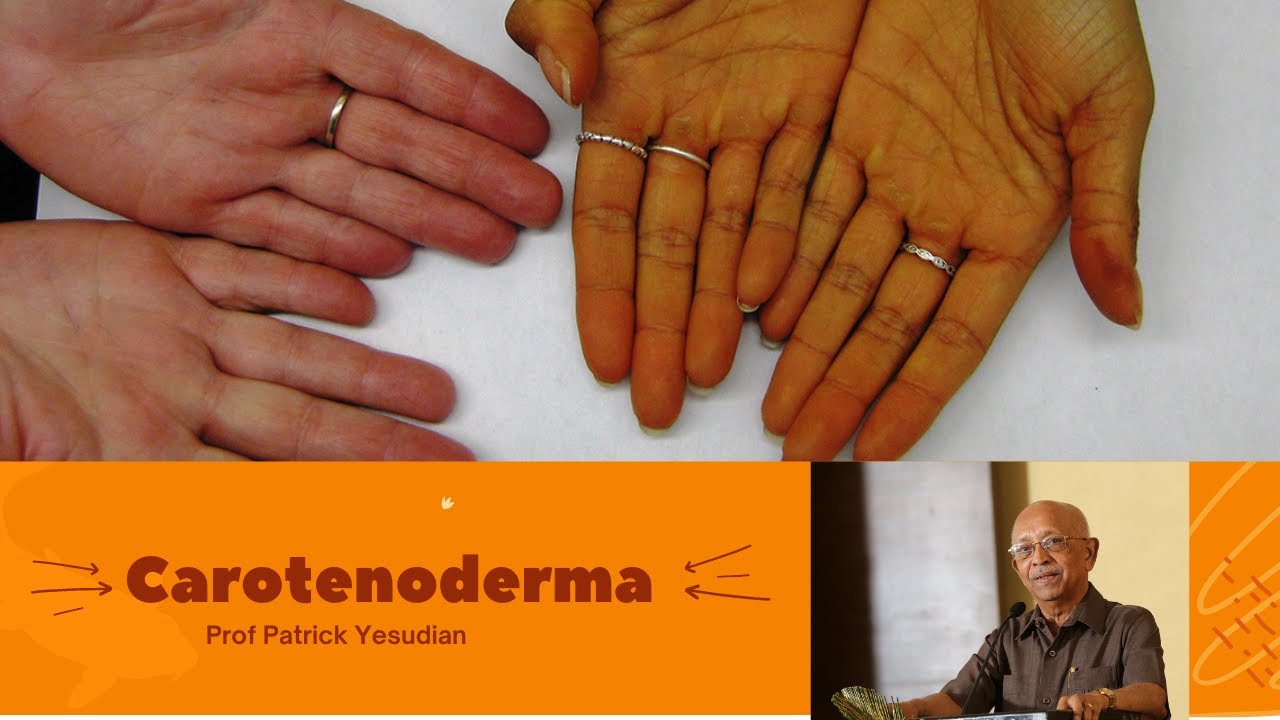 Carotenoderma A Condition Worth Knowing Youtube