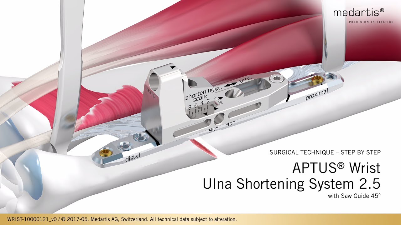 Aptus Wrist Ulna Shortening System 2 5 Surgical Technique Youtube