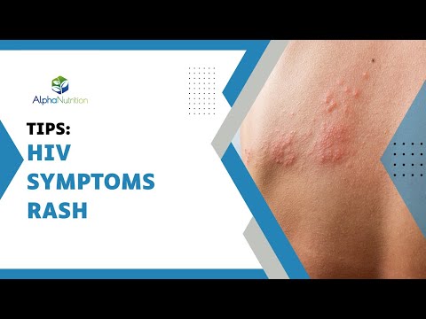 Unraveling HIV Rashes Understanding And Managing Skin Manifestations