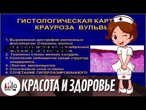 Крауроз вульвы