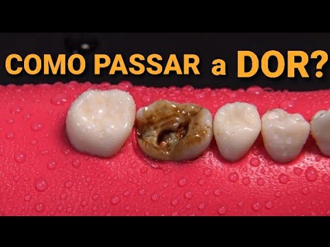 COMO PASSAR a DOR DE DENTE em 1 MINUTO! - YouTube