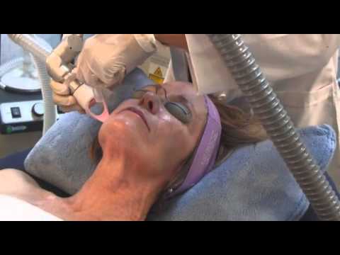 CO2 Fractional Laser Treatment  performed by Dr. Shirat Ling