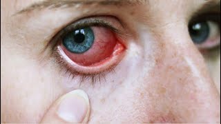 التهاب العين أعراضه ومسبباته مع طرق علاجه والوقاية منه