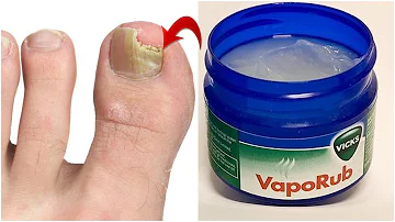 ¿Qué hace Vicks por las uñas de los pies?