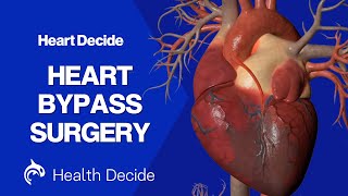 Heart Bypass Surgery Coronary Artery Bypass Graft Cabg - 3D Animation