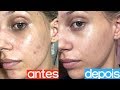 COMO TRATAR AS MANCHAS DE ACNE EM CASA