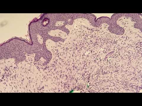 Video: Roll Af Postoperativ Strålebehandling I Dermatofibrosarcoma Protuberans: En Tilbøjelighed-matchet Analyse