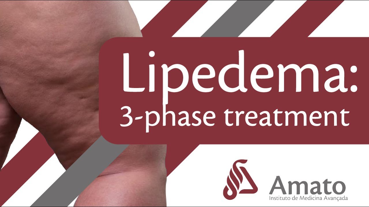 Lipedema Disease: three-phase treatment (English subs) 