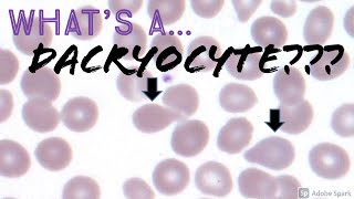 What's a DaCRYocyte?: Peripheral Blood Smear (Hematology Hematopathology) screenshot 2