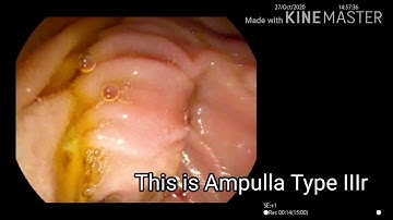 ERC : Ampulla Type IIIr Cannulation (Wavy Ampulla) - TWFC