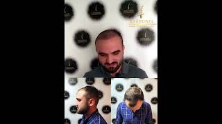 Saç Ekimi Yaptıranlardan Dinleyin Acılı Mı? Normal Hayatıma Ne Zaman Dönerim? Rasyonel Saç Ekimi