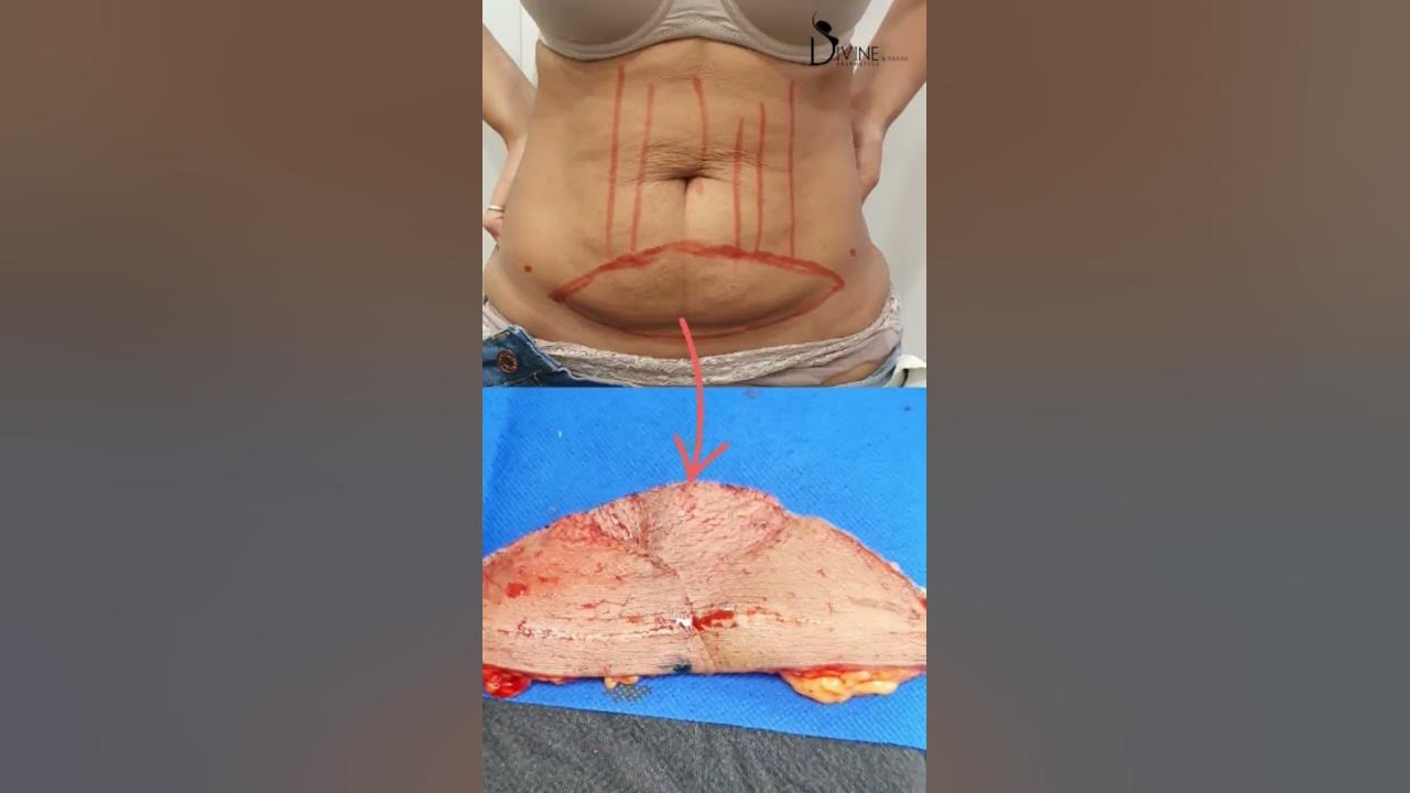 Mini Tummy Tuck: Is It Right for You? - Camille Cash, M.D.