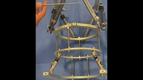 Part 1-Orthoplastic Tibial Lengthening Truelok Fra...